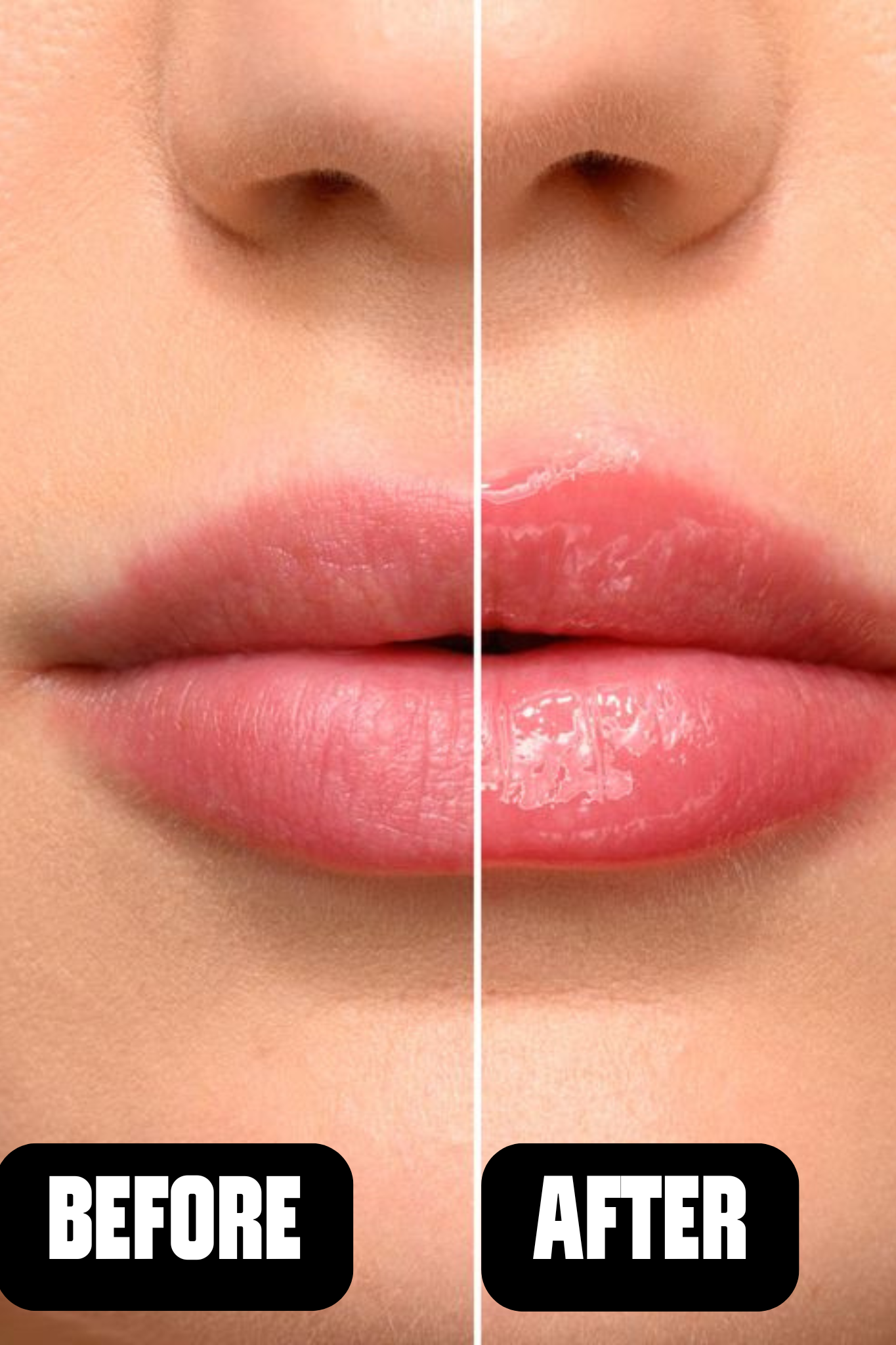 Revox Lip Filler Hyaluronic Acid